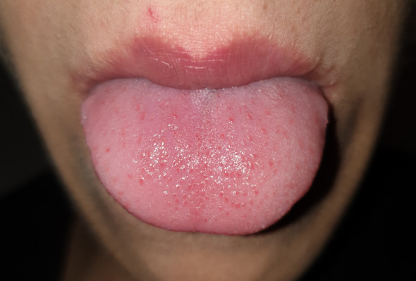 Rote Punkte auf der Zungee? (Gesundheit und Medizin, Zunge, Zungenbelag)