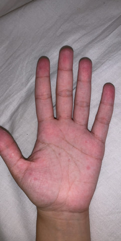 Rote Punkte Auf Handen Mit Bild Gesundheit Und Medizin Krankheit Schwitzen Rote Punkte Auf Handen Mit Bild Gesundheit Und Medizin Krankheit Schwitzen