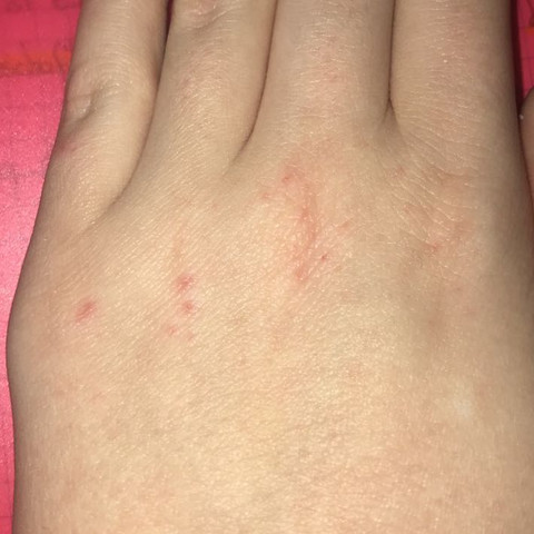 Rote Punkte Auf Hand Gesundheit Rote Punkte Auf Hand Gesundheit