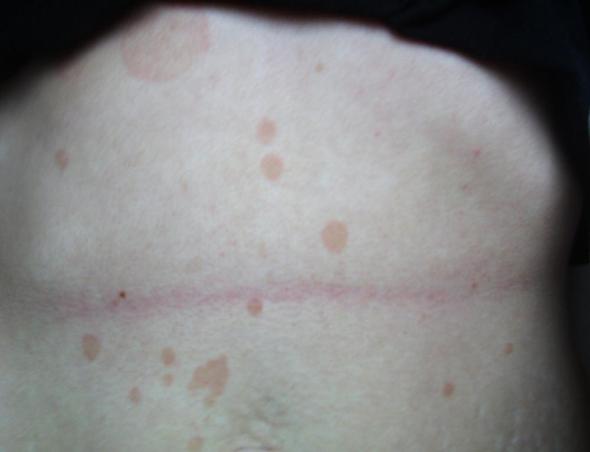Rote Punkte Auf Meiner Haut Gesundheit Bauch Rot Rote Punkte Auf Meiner Haut Gesundheit Bauch Rot