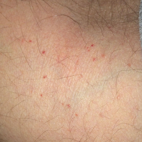 Rote Punkte - (Krankheit, Haut, rot)