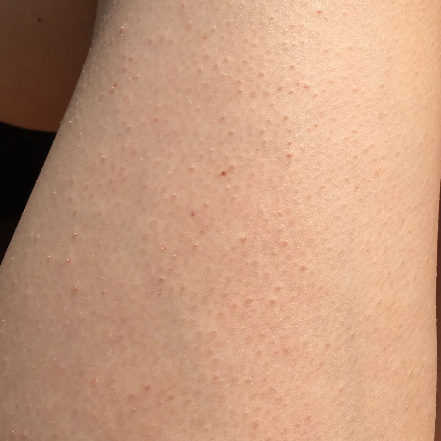 Rote Punkte auf Oberschenkel. Was tun? (rote-punkte) pickel auf dem oberschenkel