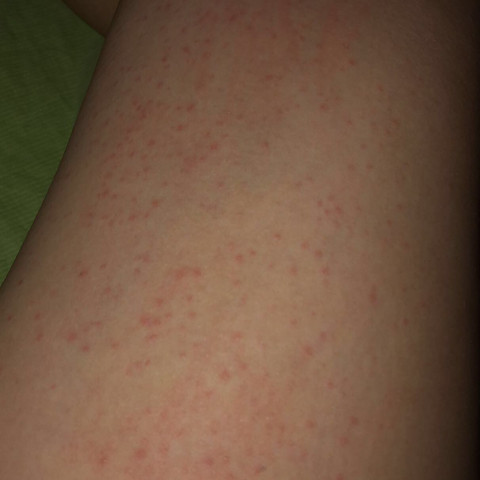 Rote Punkte Auf Oberschenkeln Gesundheit Und Medizin Gesundheit Beine