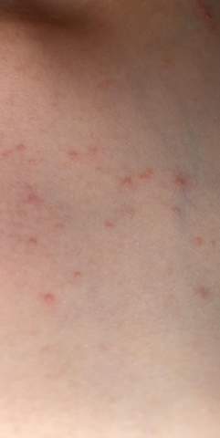 Rote Punkte Beim Kurz Unter Dem Hals Was Ist Das Gesundheit Und Medizin Haut Hautkrankheit Rote Punkte Beim Kurz Unter Dem Hals Was Ist Das Gesundheit Und Medizin Haut Hautkrankheit