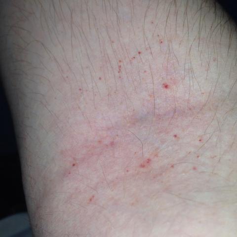 Rote Punkte Blutvergiftung Gesundheit Haut Rote Punkte Blutvergiftung Gesundheit Haut