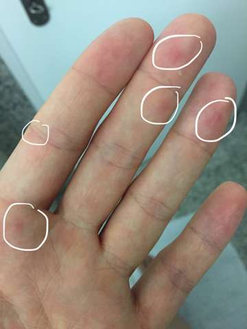 Rote Punkte Handinnenfläche? (Gesundheit, Haut)