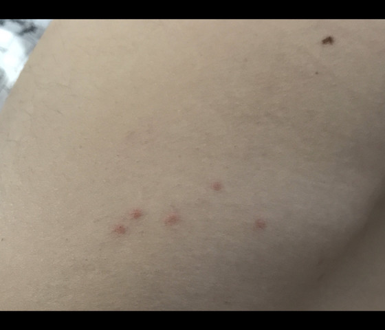 Rote Punkte Im Unteren Bauch Bereich Gesundheit Und Medizin Rote Punkte Im Unteren Bauch Bereich Gesundheit Und Medizin