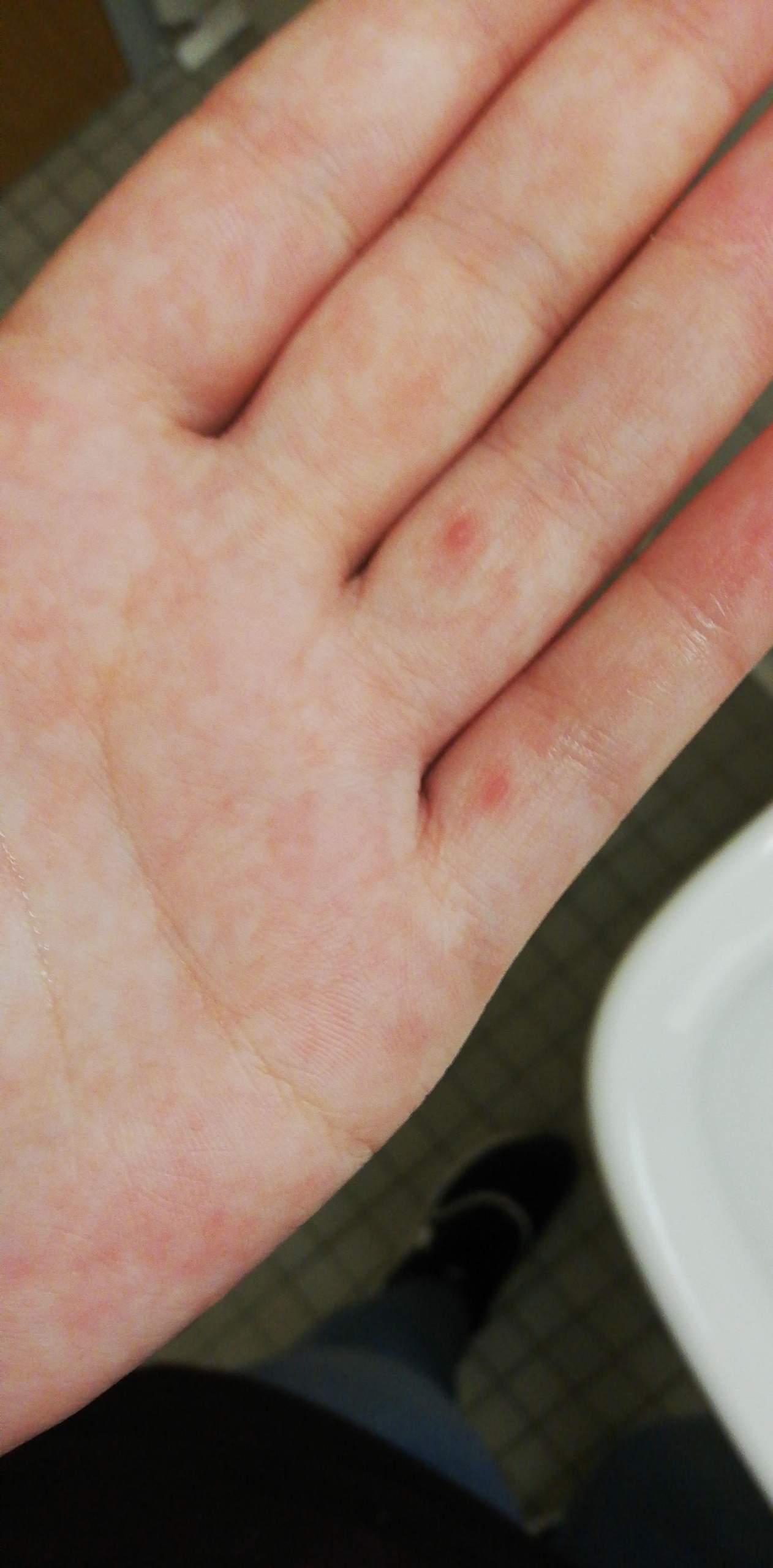 Rote Punkte mit blasen an den Händen? (Gesundheit, Medizin, Krankheit)
