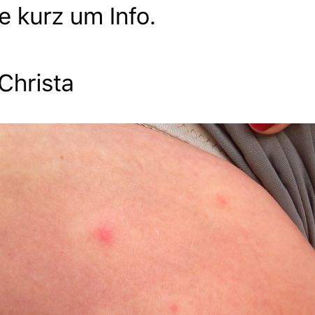 Rote Punkte Mit Weissem Ring Was Kann Das Sein Krankheit Haut Rot Rote Punkte Mit Weissem Ring Was Kann Das Sein Krankheit Haut Rot