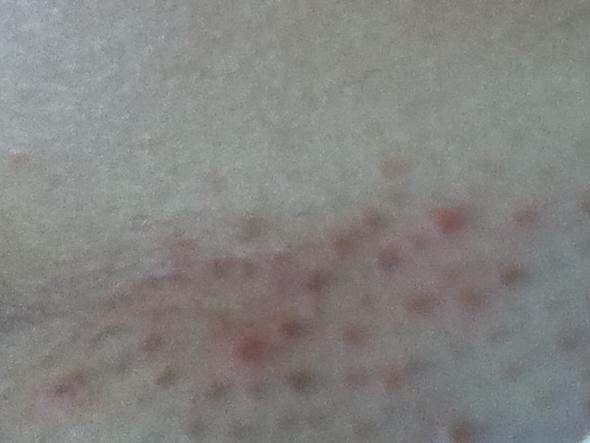 Rote Punkte Nach Der Rasur S Rasieren