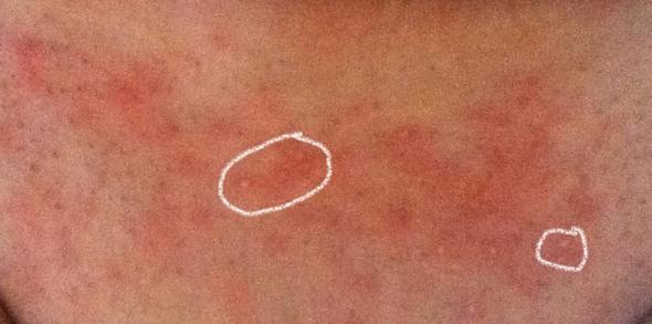 Rote Punkte Nach Rasieren Ausschlag