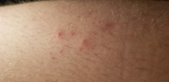 rote punkte oberschenkel gesundheit