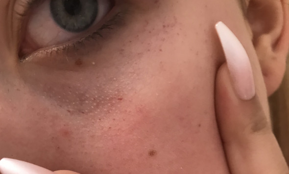 Rote Punkte Unter Dem Auge Gesundheit Arzt Augen Rote Punkte Unter Dem Auge Gesundheit Arzt Augen