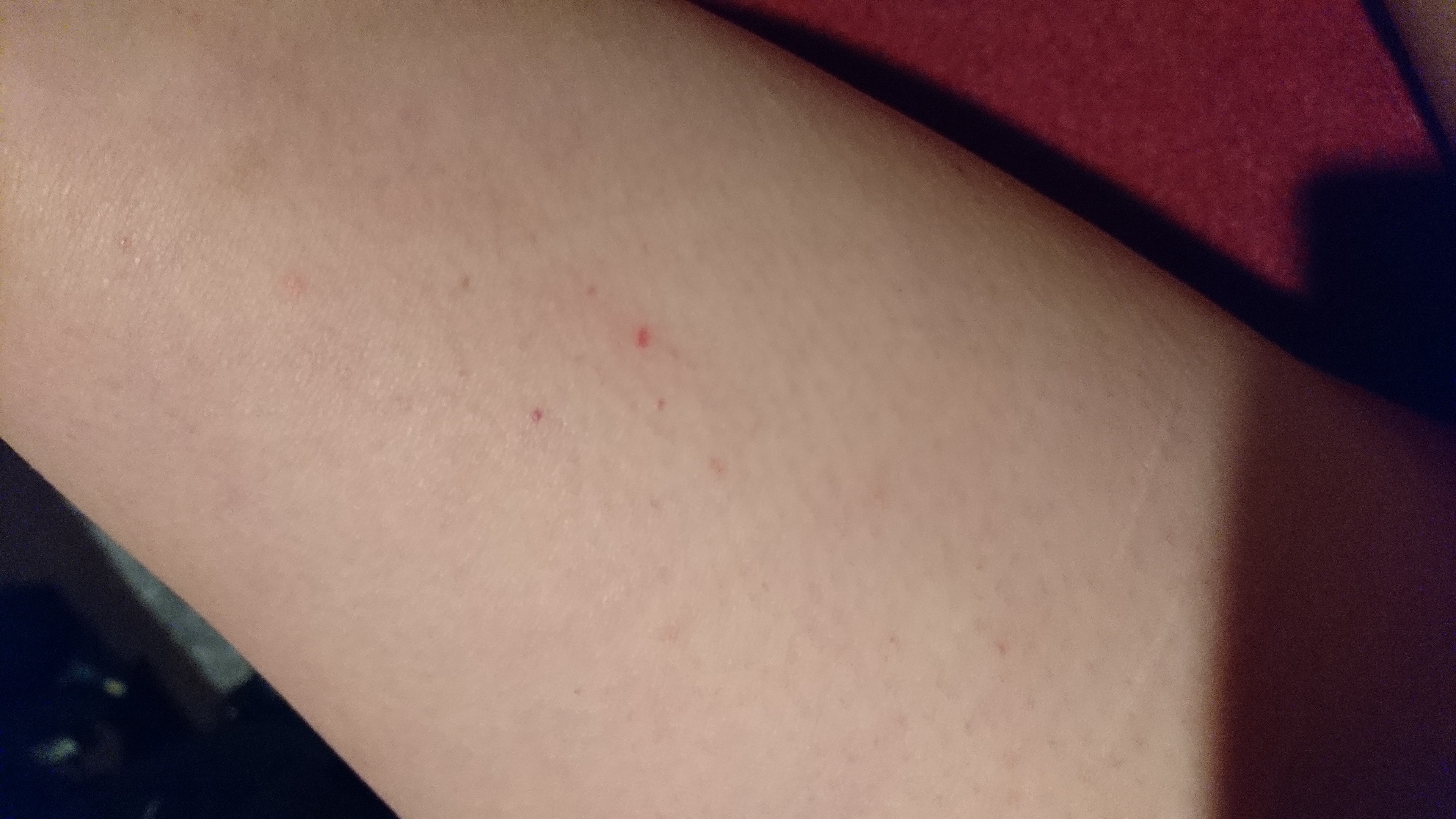 Kleine Weisse Pickel Unter Eichel Weisse Unter Der Eichel 2020 03 21