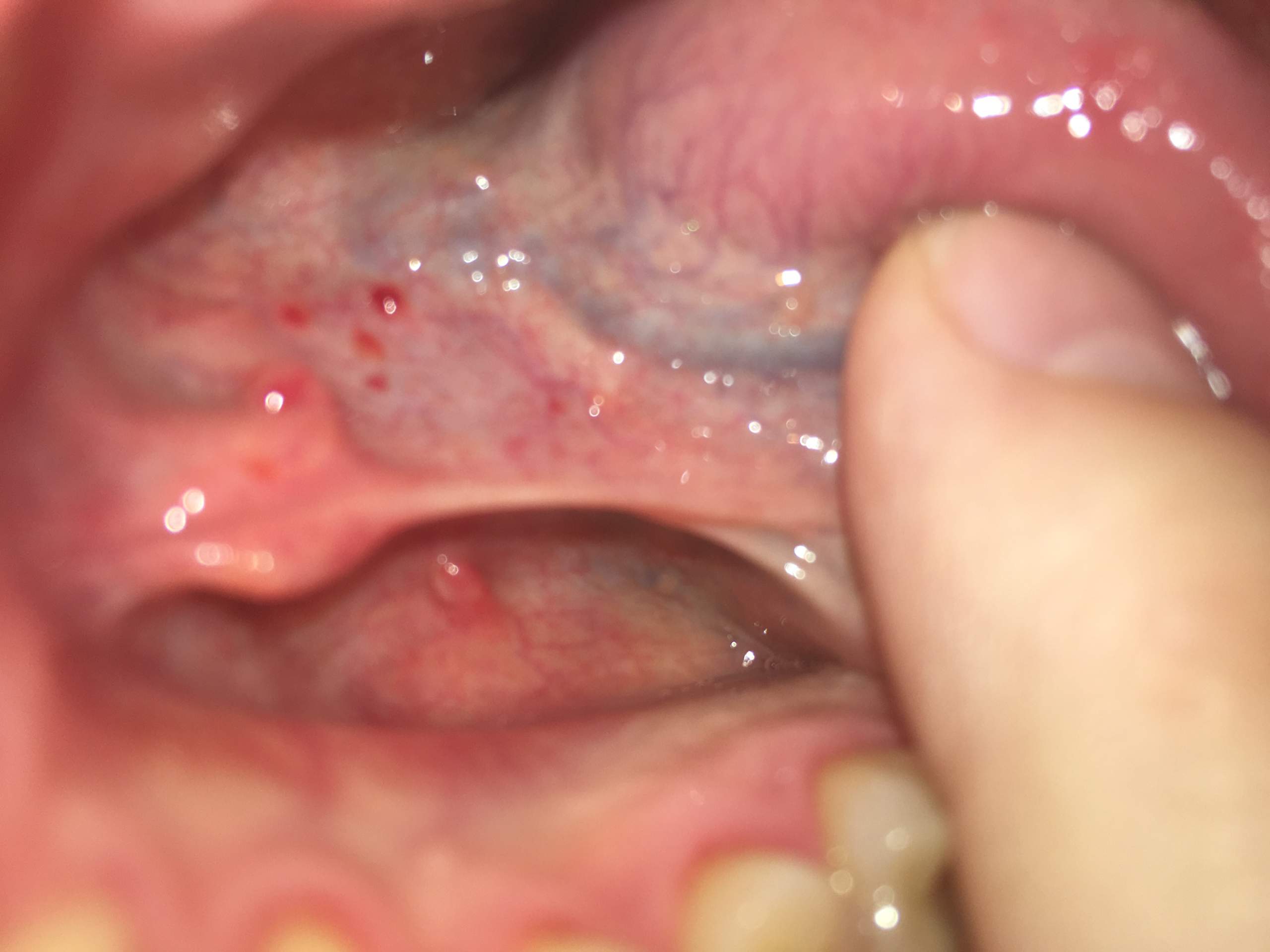 Rote Punkte Unter Der Zunge Medizin Rat Rote Punkte Unter Der Zunge Medizin Rat