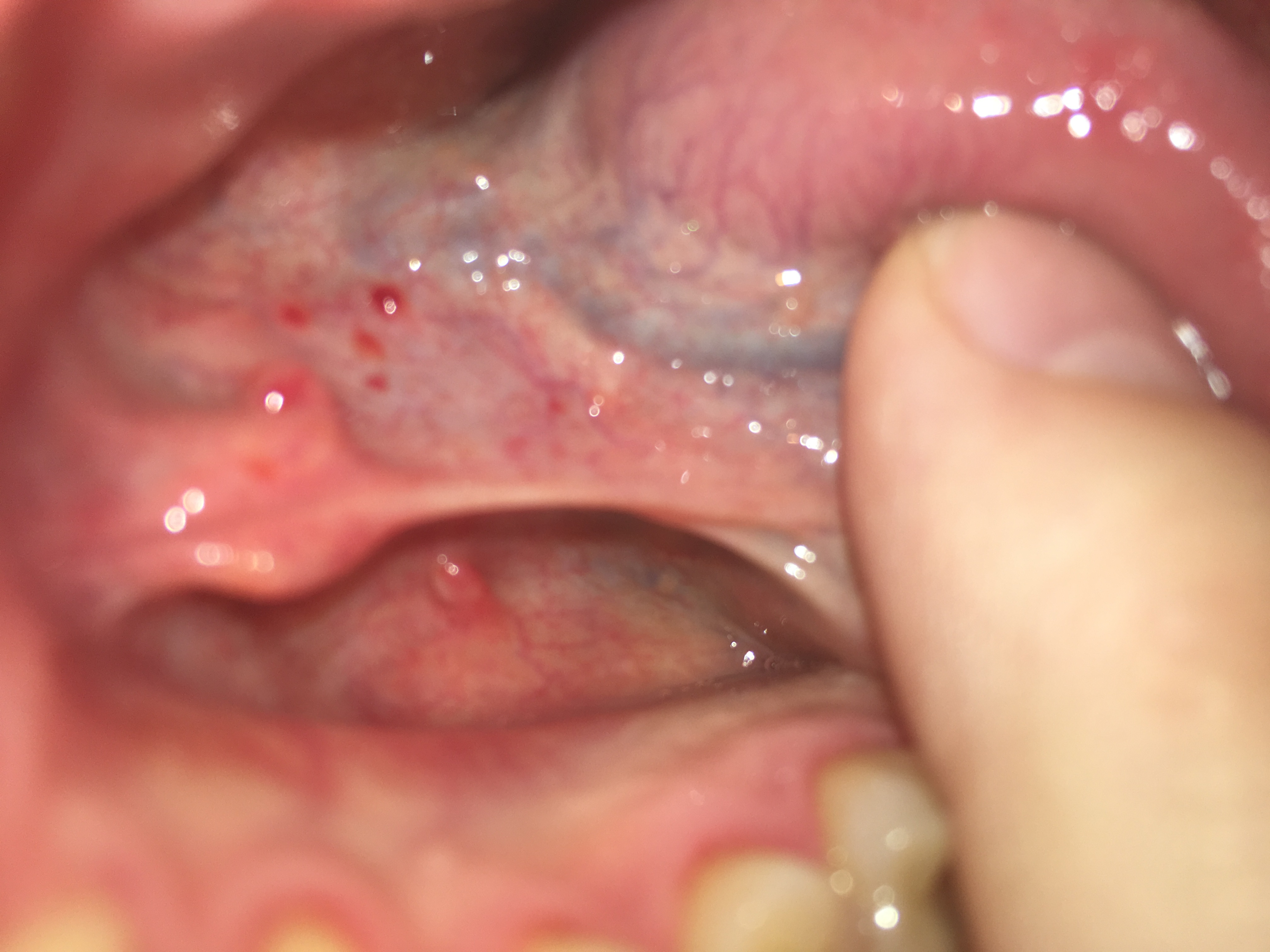 23+ Pickel Auf Der Zunge Ohne Schmerzen Pics