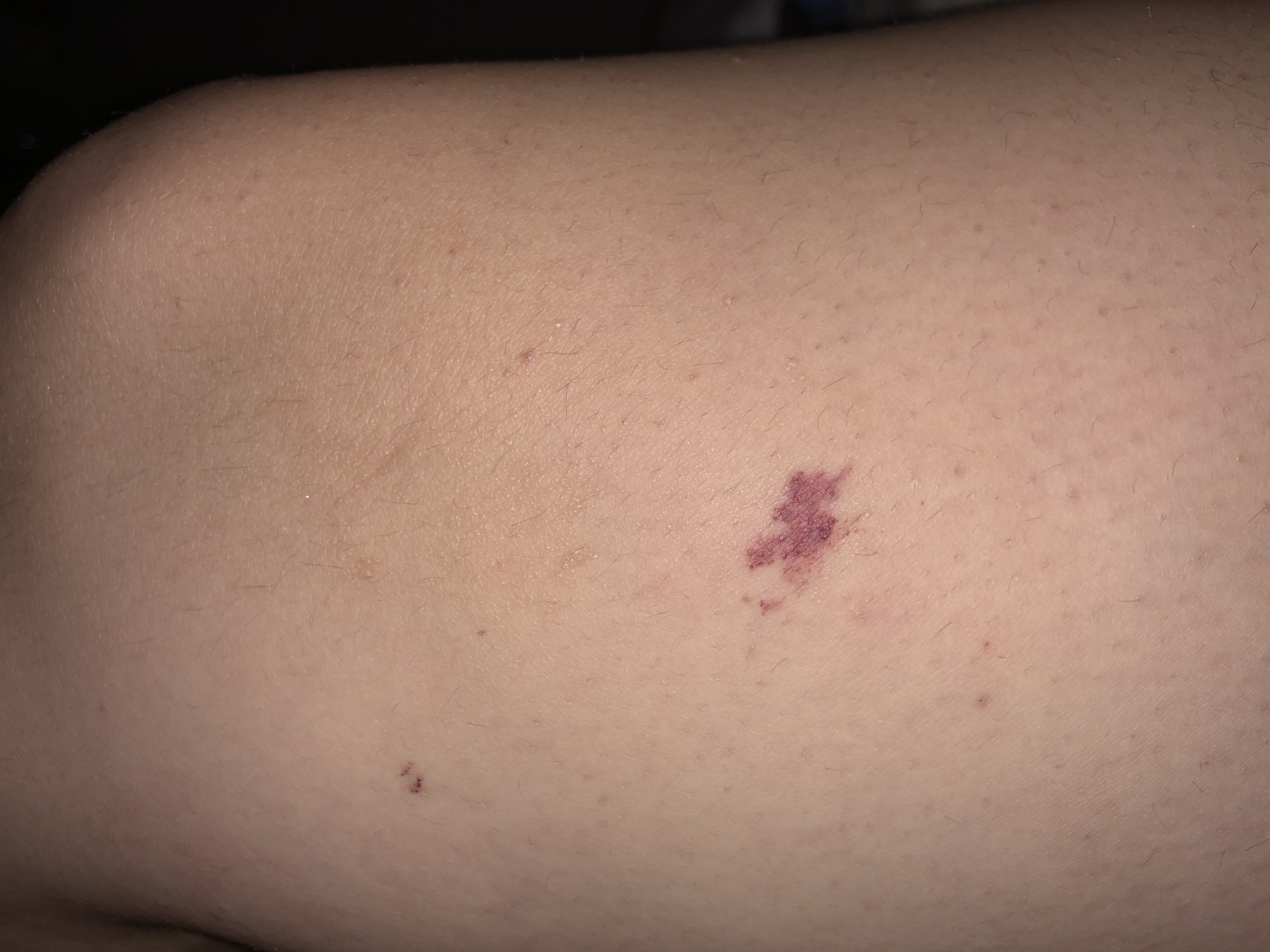 Rote Punkte wie bei einem Bluterguss? (Gesundheit, rotepunkte)