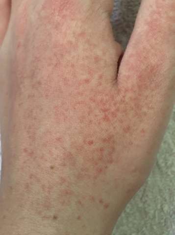 Rote Punkte Ausschlag Auf Der Hand Gesundheit Und Medizin Haut Solarium Rote Punkte Ausschlag Auf Der Hand Gesundheit Und Medizin Haut Solarium