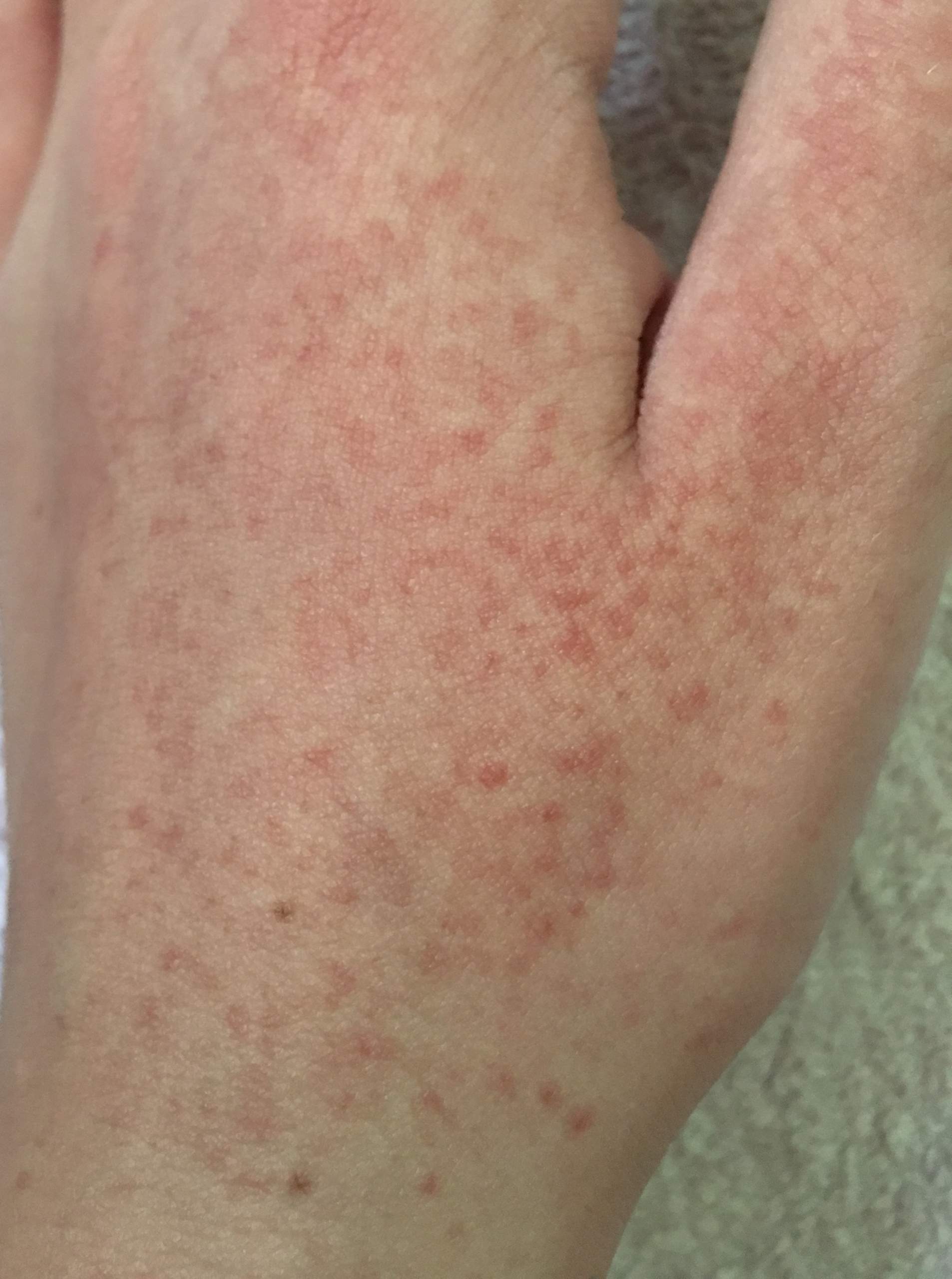 Rote Punkte/Ausschlag auf der Hand? (Gesundheit und Medizin, Haut ...