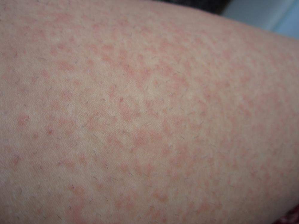 Rote Punkte/Pickel an den Oberschenkeln? (Beine, rote-punkte) pickel an oberschenkel