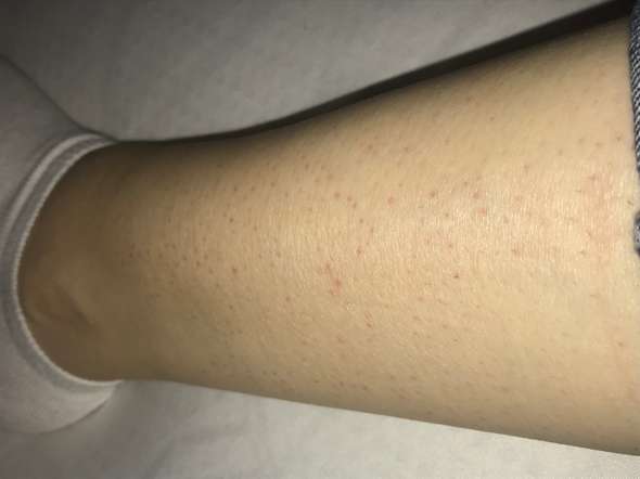 Rote Punkte Pickel Nach Rasieren Gesundheit Und Medizin Gesundheit Haut