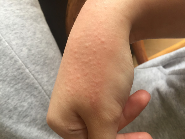 Rote Pusteln An Der Hand Gesundheit Und Medizin Gesundheit Haut Rote Pusteln An Der Hand Gesundheit Und Medizin Gesundheit Haut