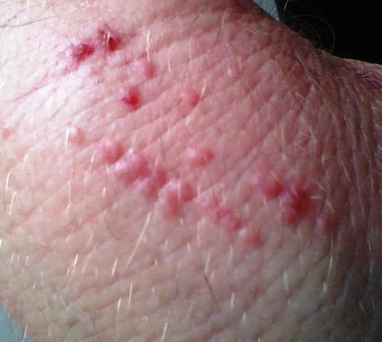 Rote Pusteln an Händen und Unterarmen? (Gesundheit und Medizin, Haut, Pickel) pickel auf der hand