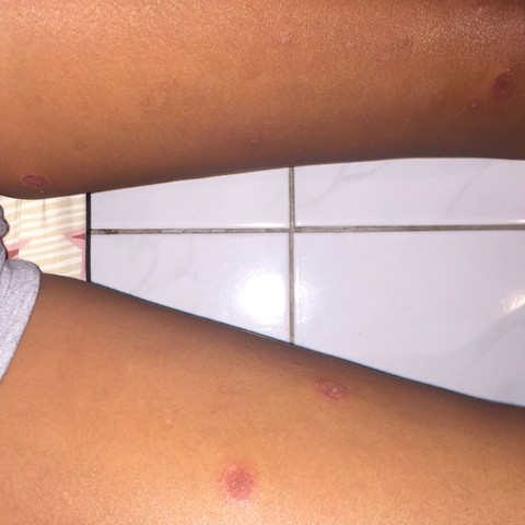 Beine  - (Ring, Mückenstich, Hautpilzkrankheit)