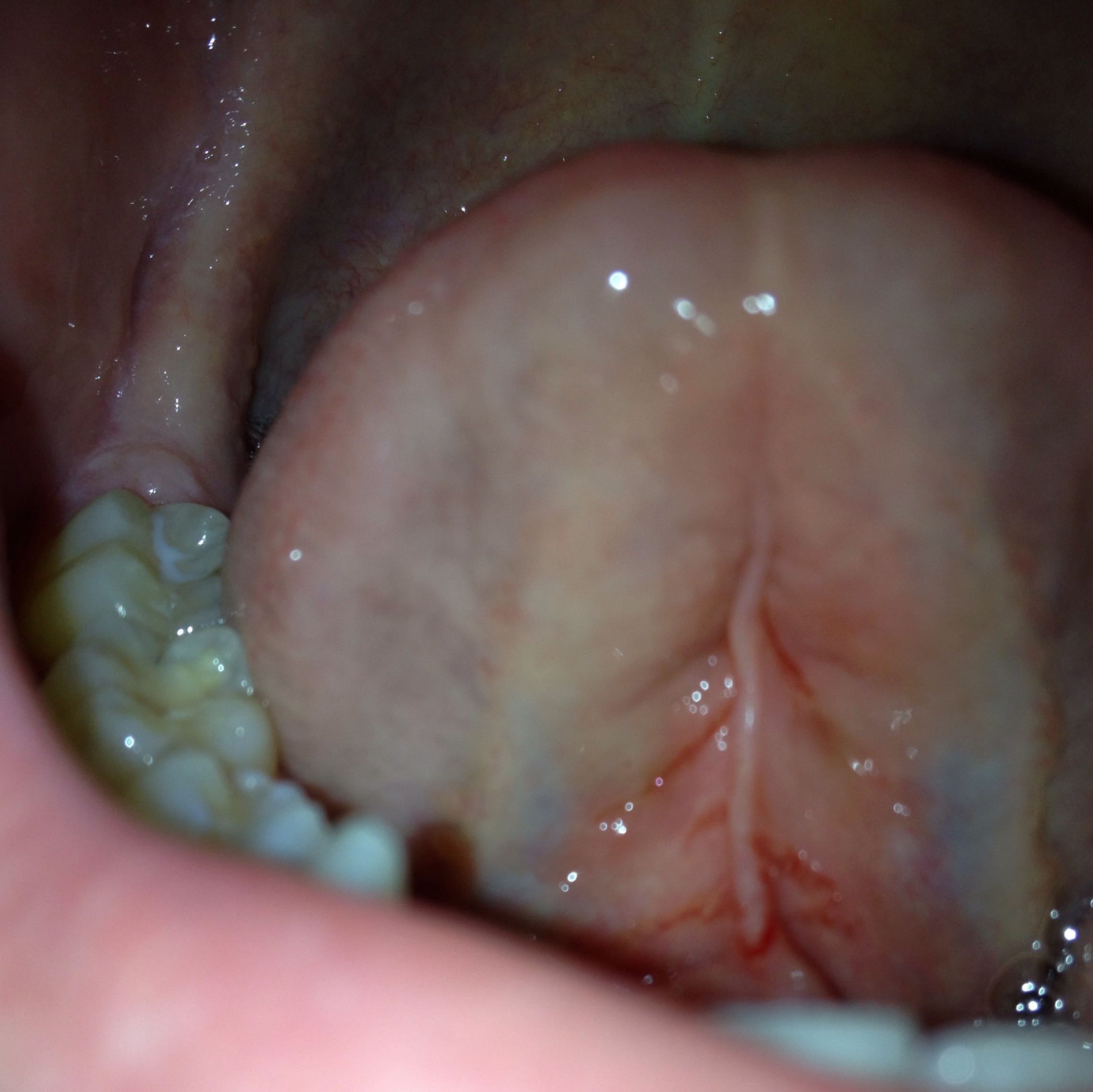 Rote Risse Unter Der Zunge Medizin Arzt Krankheit Rote Risse Unter Der Zunge Medizin Arzt Krankheit