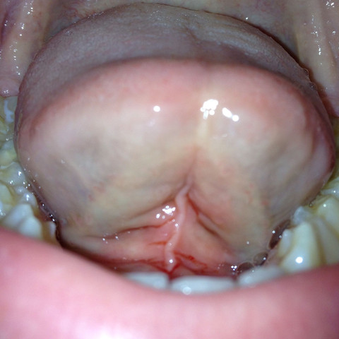 Rote Risse Unter Der Zunge Medizin Arzt Krankheit Rote Risse Unter Der Zunge Medizin Arzt Krankheit