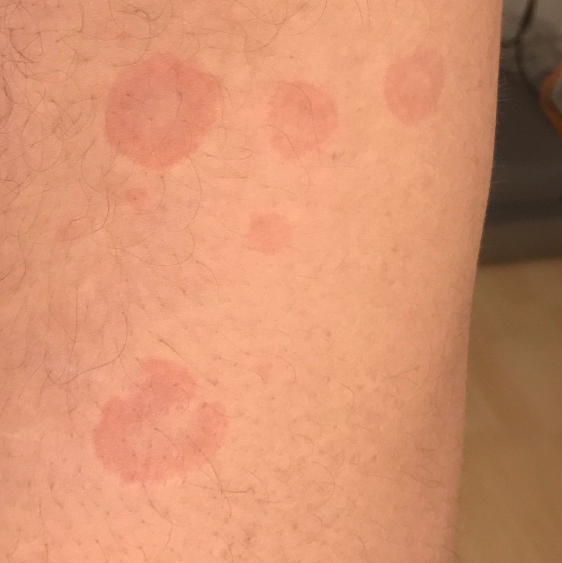 Warum habe ich rote runde Flecken an den Oberschenkeln? (Gesundheit, Haut, Hautkrankheit)