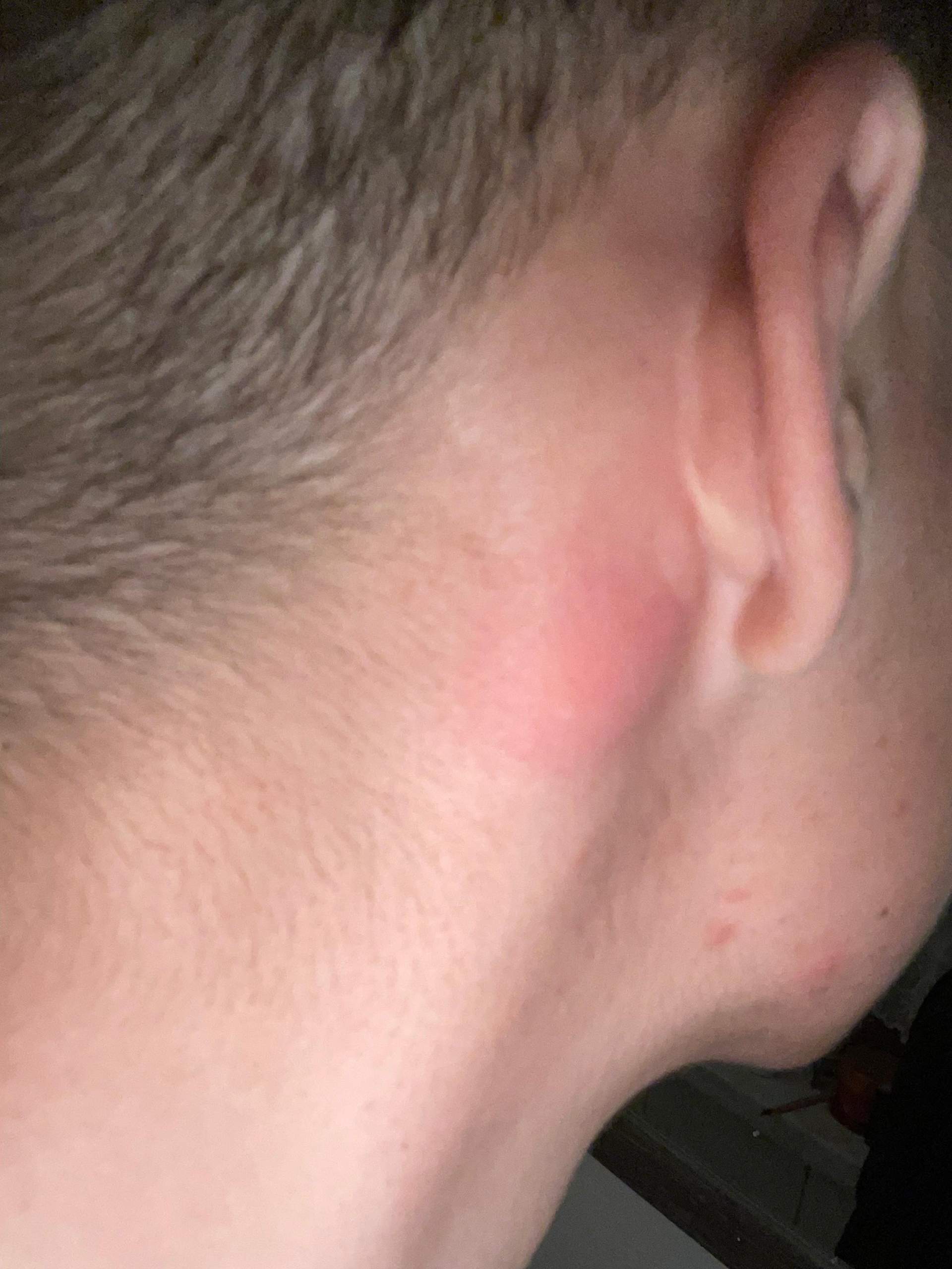 Rote Schwellung am Kopf? (Gesundheit und Medizin)