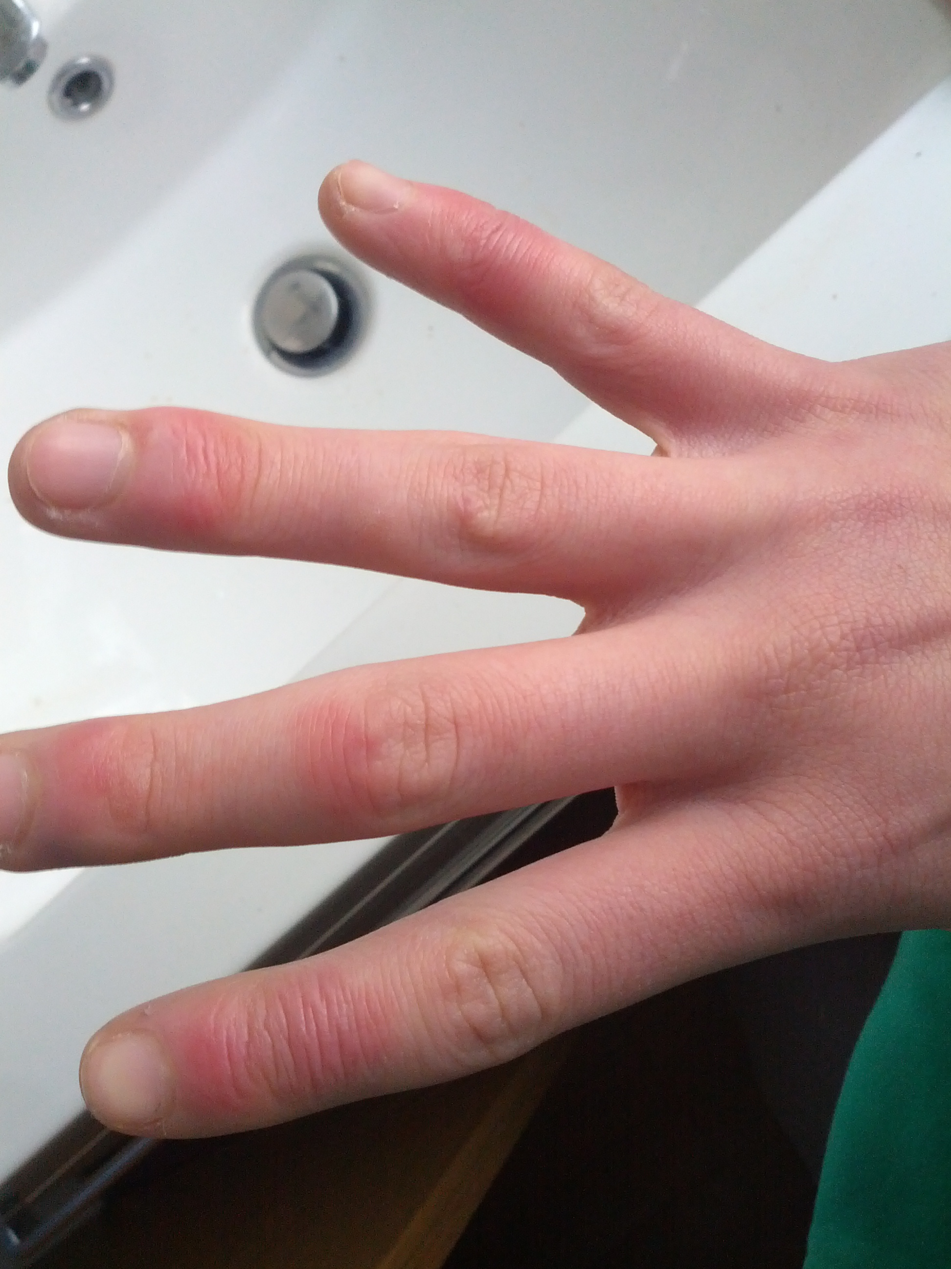 Rote Schwellungen auf den Fingern (Hand, Finger, Schwellung)