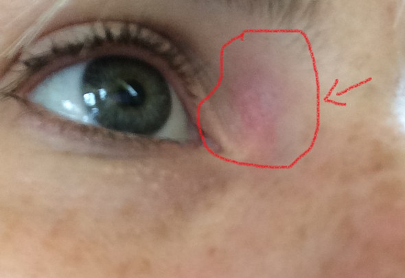 Auge rechts - (Haut, Augen, rot)