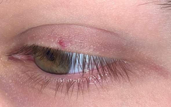 Rote Stelle Auf Augenlid Gesundheit Und Medizin Augen Rote Stelle Auf Augenlid Gesundheit Und Medizin Augen