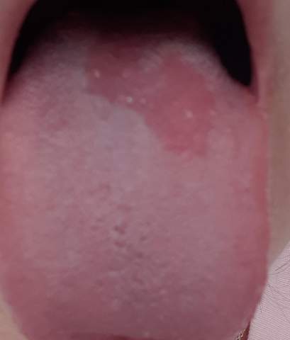 Rote stelle auf der zunge? (Gesundheit und Medizin)