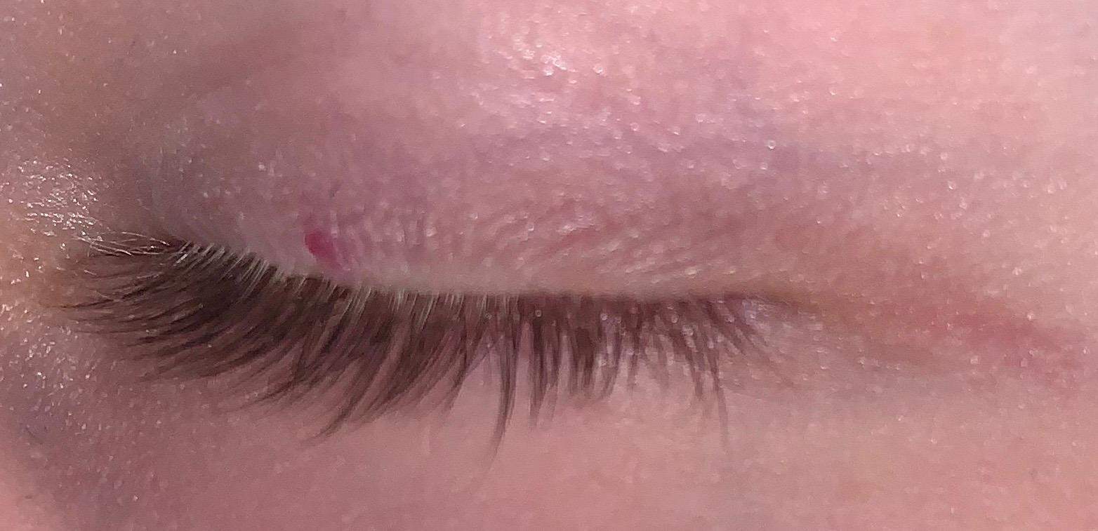 Rote Stelle auf oberen Augenlid? (Gesundheit und Medizin)