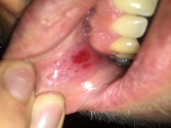 Roter Fleck im Mund  - (Gesundheit und Medizin, Mund, Herpes)
