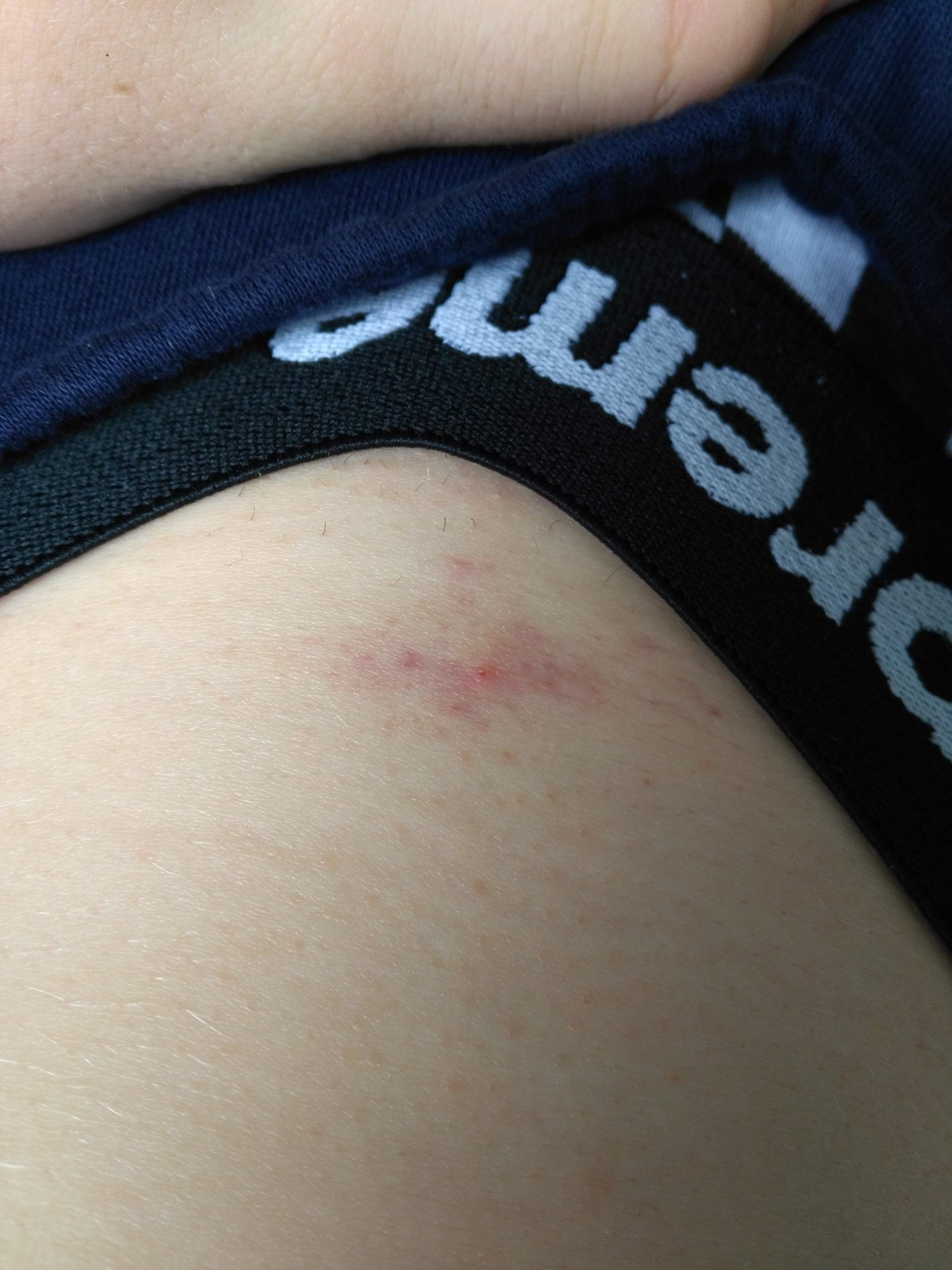 Rote Stellen Intimbereich? (Ausschlag, Rötung)