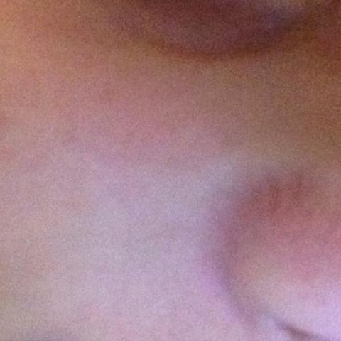 Rote Stellen Um Der Nase Wegbekommen Rot Rote Stellen Um Der Nase Wegbekommen Rot