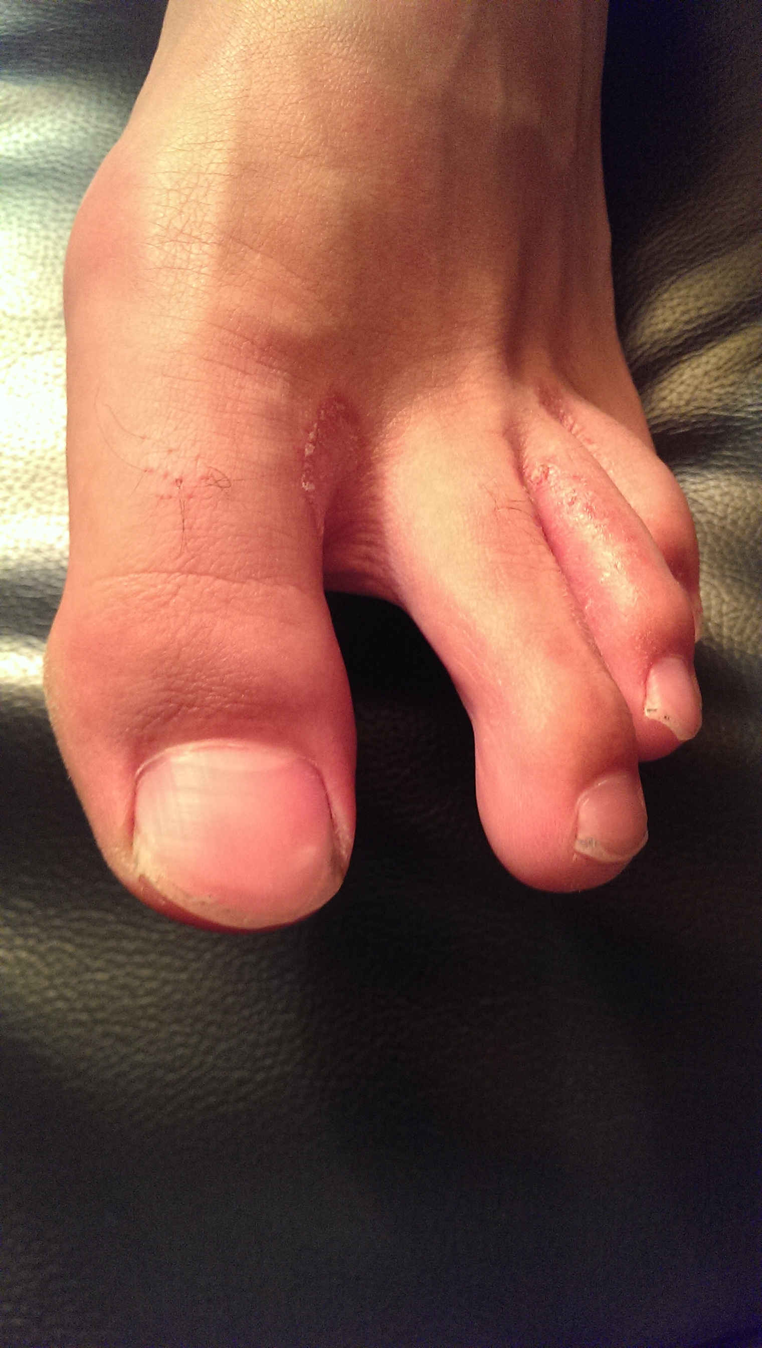 rote stellen zwischen den zehen (Haut, Füße, Pilze)
