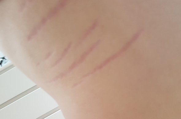 Plötzlich Rote Streifen Am Bein