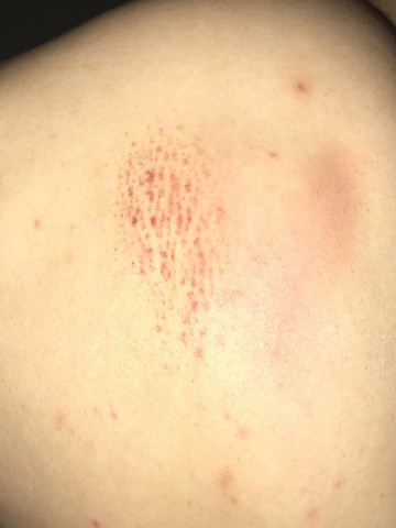 Rote Streifen Unter Der Haut Medizin Arzt Rote Streifen Unter Der Haut Medizin Arzt