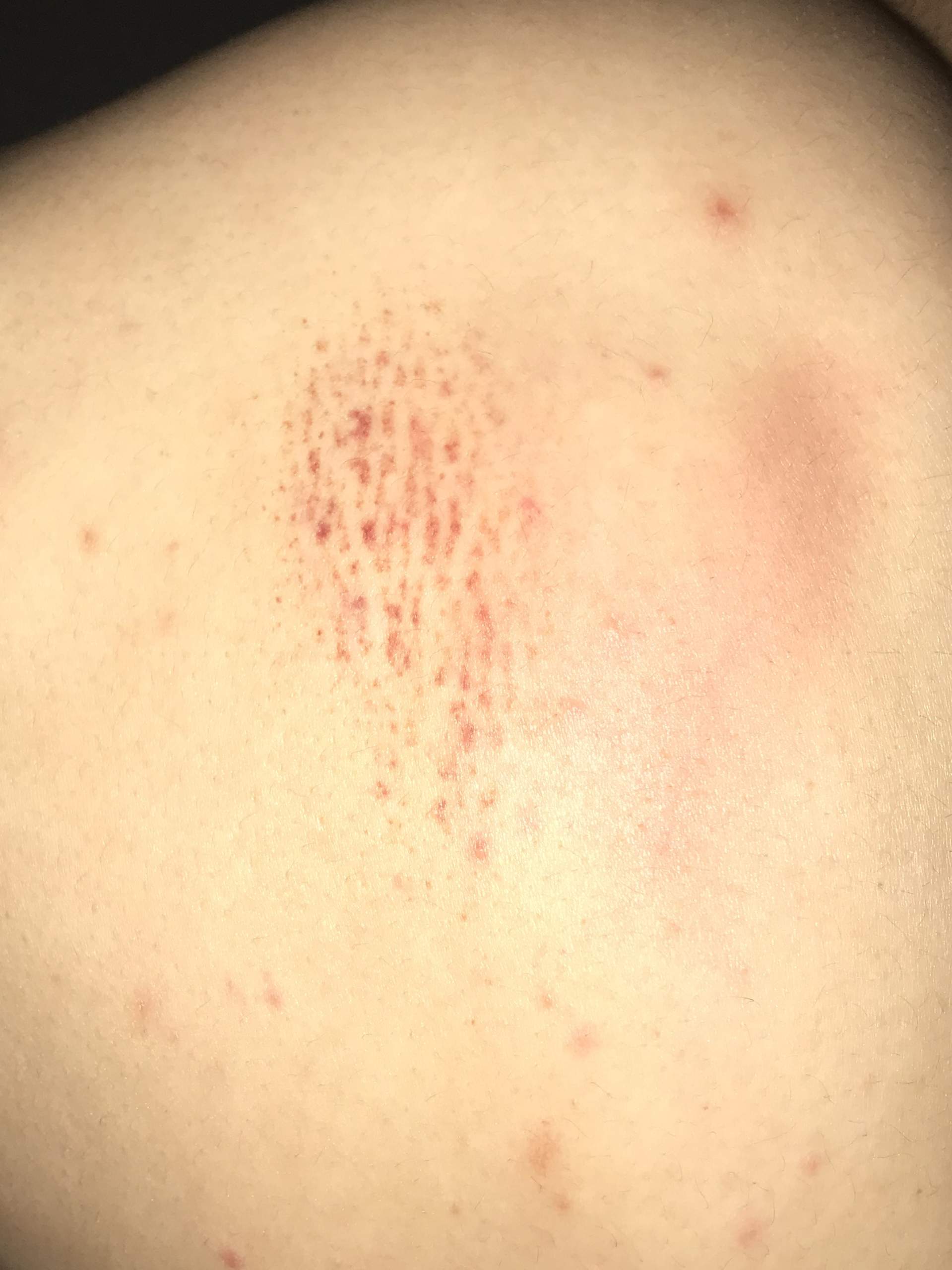 Rote Streifen Unter Der Haut Medizin Arzt Rote Streifen Unter Der Haut Medizin Arzt