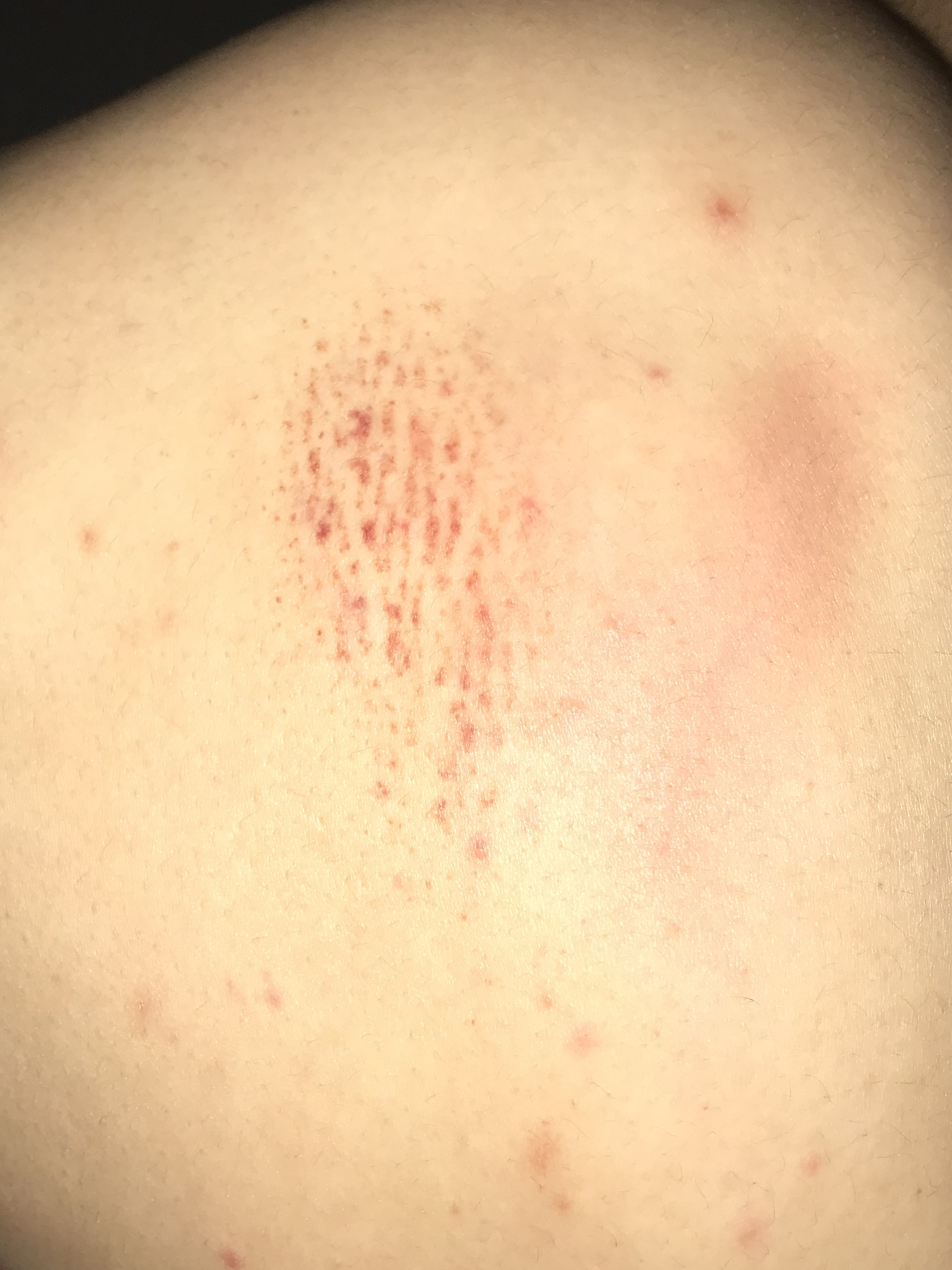 Lymphangitis Rote Streifen Auf Der Haut