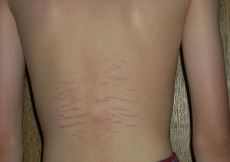 Was sind das für rote Striche am Bauch? (Junge, Gewicht) Was sind das für rote Striche am Bauch? (Junge, Gewicht)