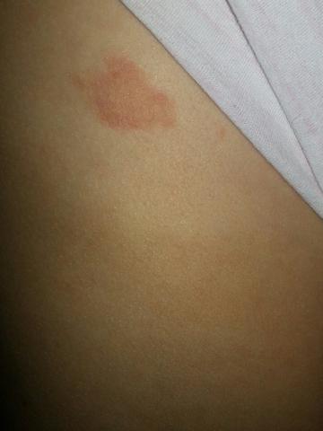 Rote Trockene Stellen Allergie Trockene Haut Rote Trockene Stellen Allergie Trockene Haut