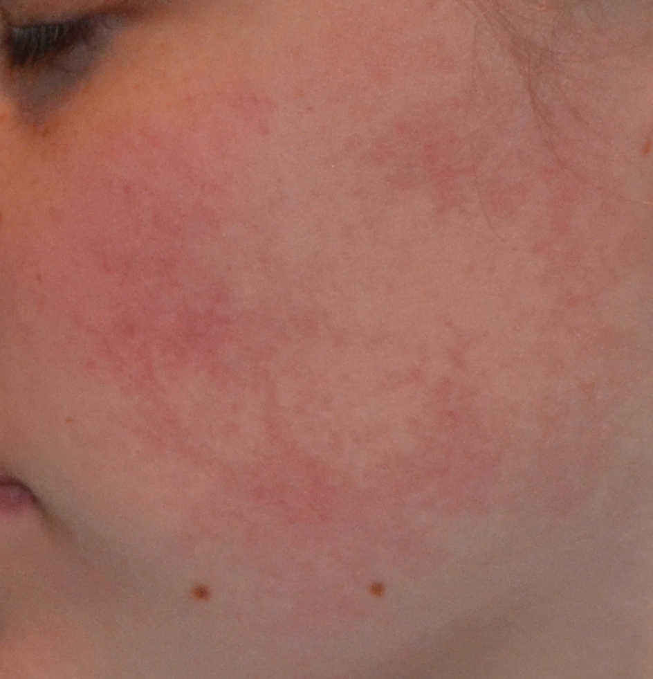 ROTE WANGEN -.- (Haut, Gesicht, rot)