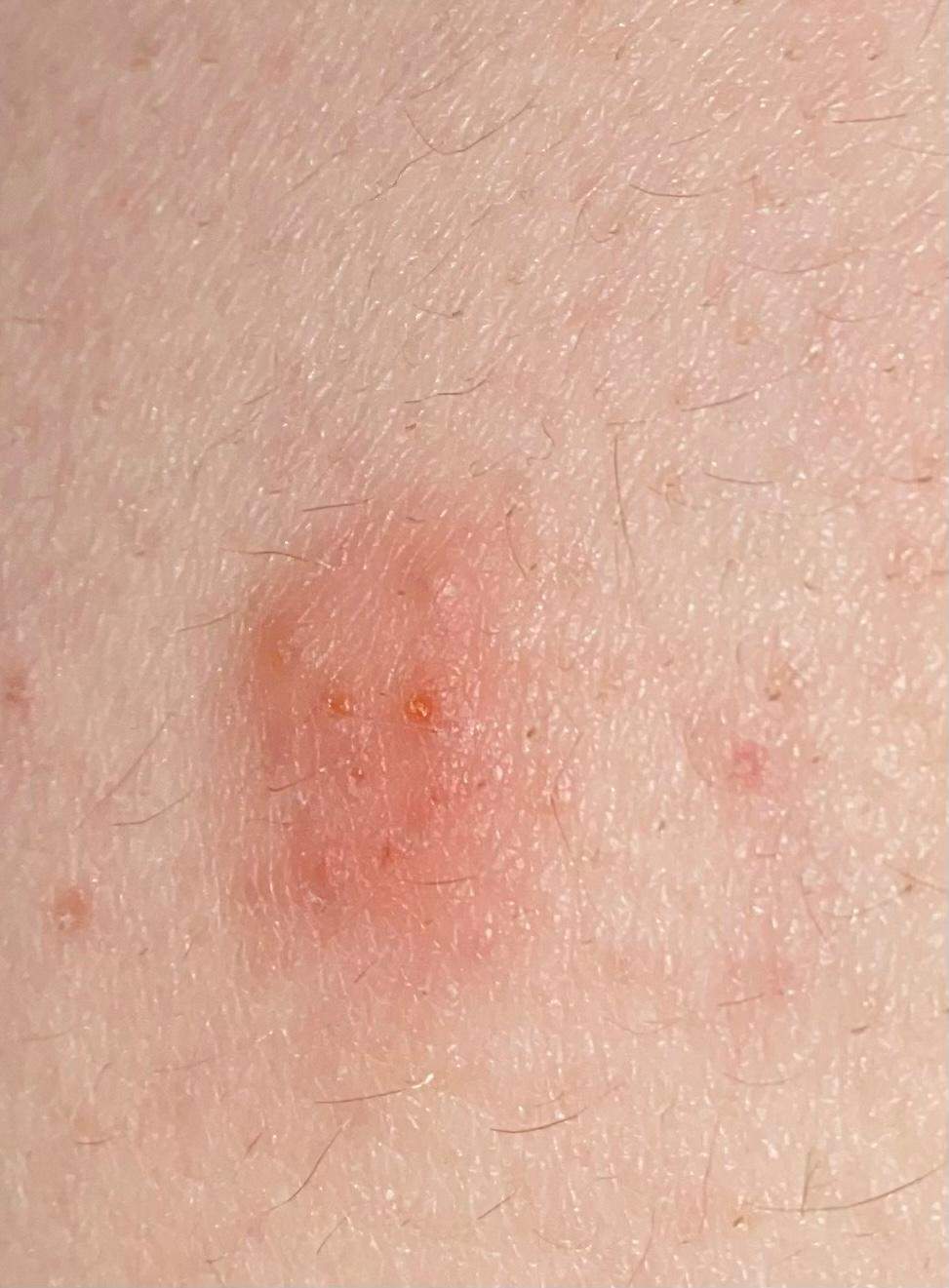 Rote Wunde am Po? (Gesundheit und Medizin)