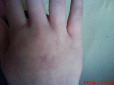 meine Hand  - (Krankheit, Blut, Hand)